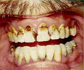 Restoring Tooth Enamel